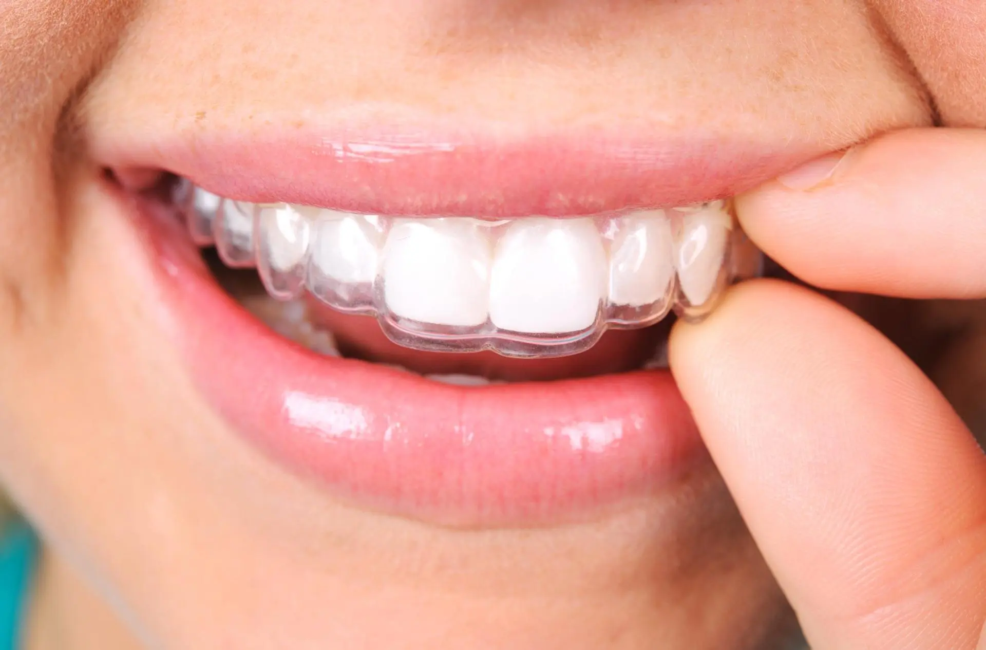 Advantages of Having Straight Teeth