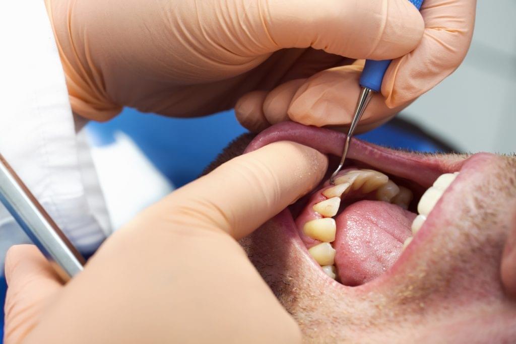 gum disease